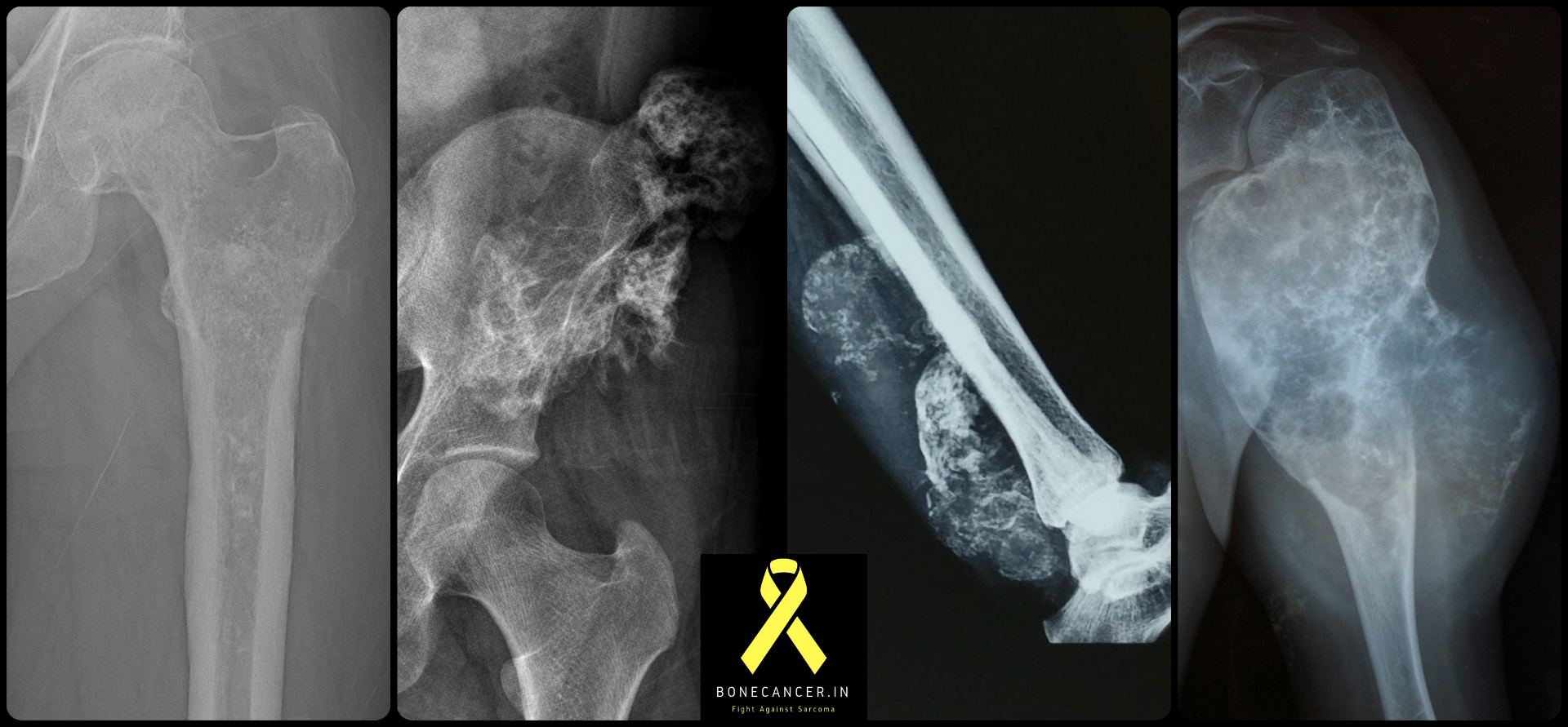 Radiographs of chondrosarcoma at different sites — proximal femur, pelvis, distal forearm and proximal humerus — showing ring-and-arc cartilage mineralisation, cortical destruction and soft-tissue extension.