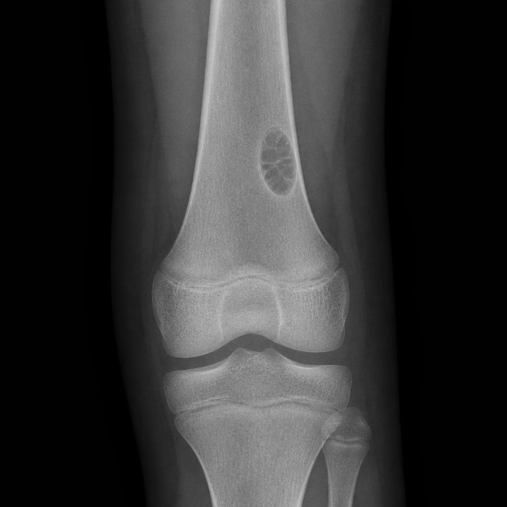 X-ray of a child's knee showing a non-ossifying fibroma in the distal femur — a well-defined, eccentric cortical lytic lesion with sclerotic margins and a bubbly multiloculated pattern, with no cortical destruction or periosteal reaction.