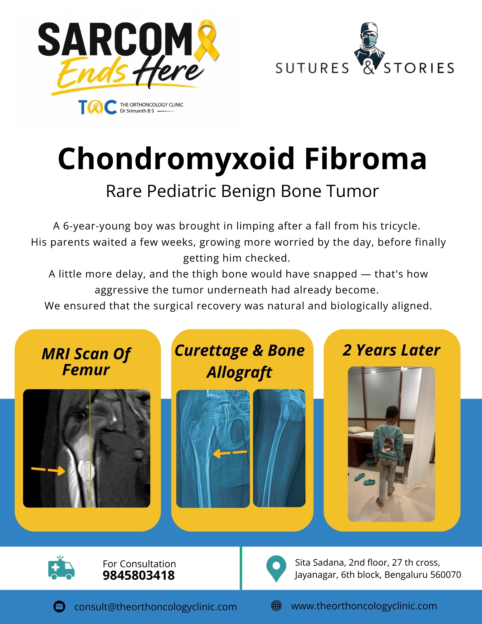 Chondromyxoid Fibroma of Femur in a 6-year-old