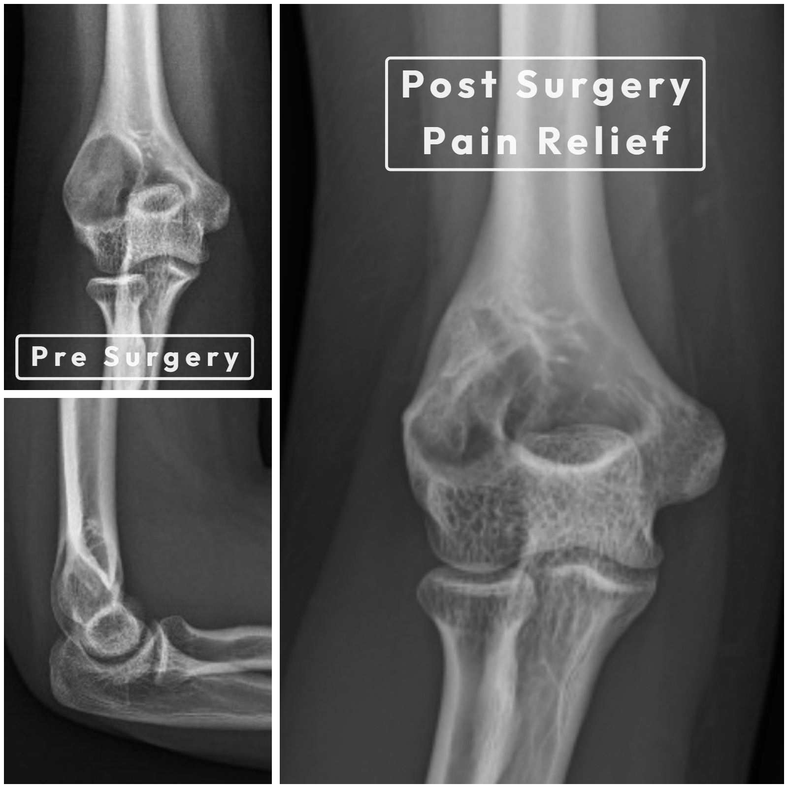 X-ray collage of fibrous dysplasia of the distal humerus at the elbow — pre-surgery ground-glass lesion and post-surgery pain relief after curettage and stabilisation.