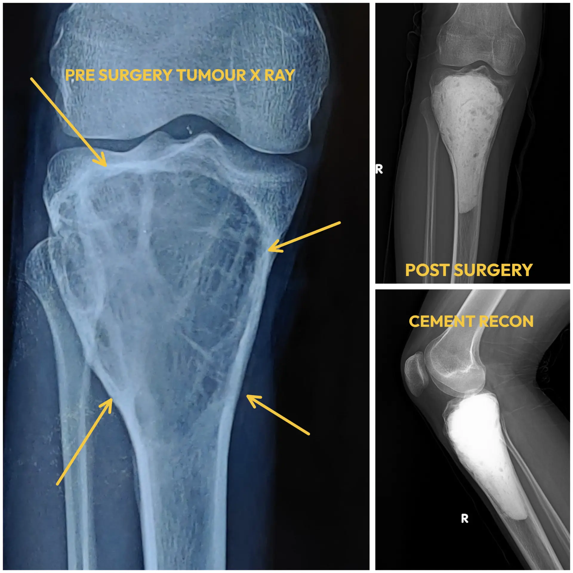 Case capsule X-rays of a giant cell tumour of the knee in a young cricketer — pre-surgery radiograph showing the lytic tumour destroying the upper tibia, and post-surgery views after extended curettage with bone cement reconstruction