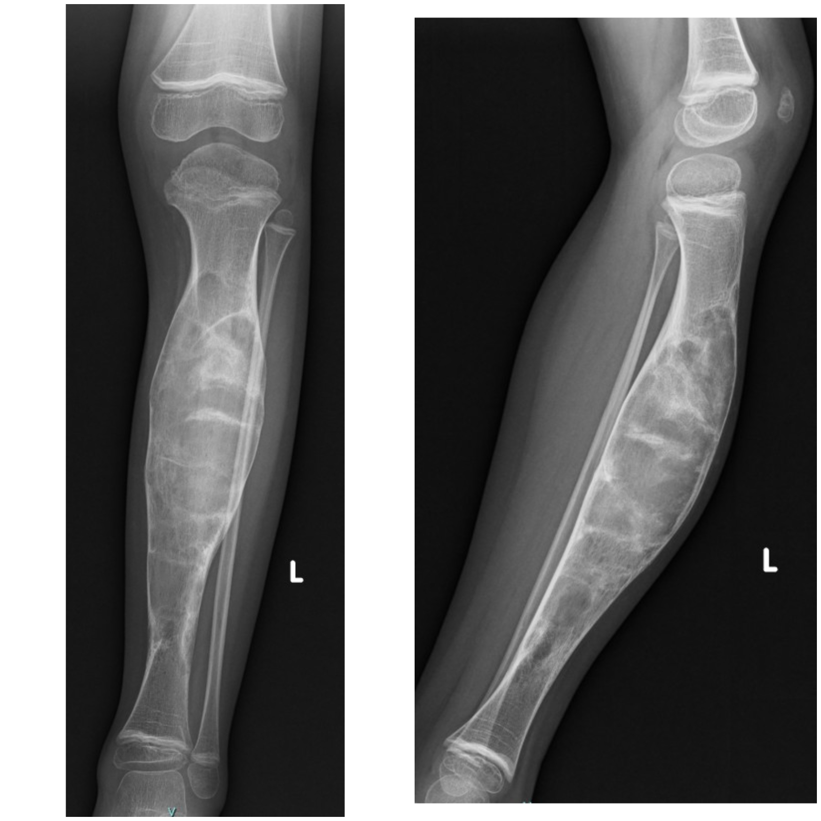 AP and lateral X-rays of the left tibia in a 4-year-old child showing osteofibrous dysplasia — a lytic, intracortical lesion in the anterior mid-diaphysis of the tibia with a sclerotic rim and mild anterior bowing, managed with observation.