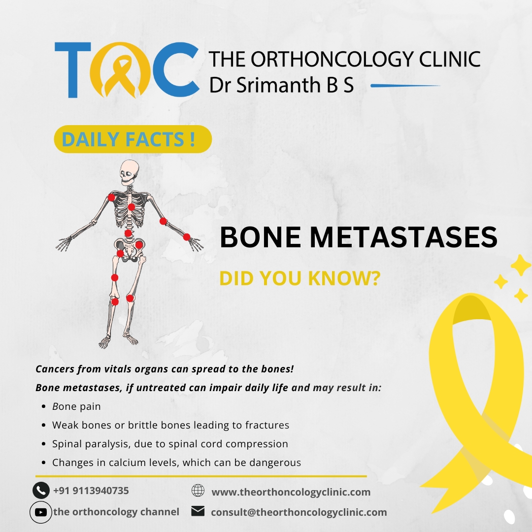 Bone Metastases — Daily Facts