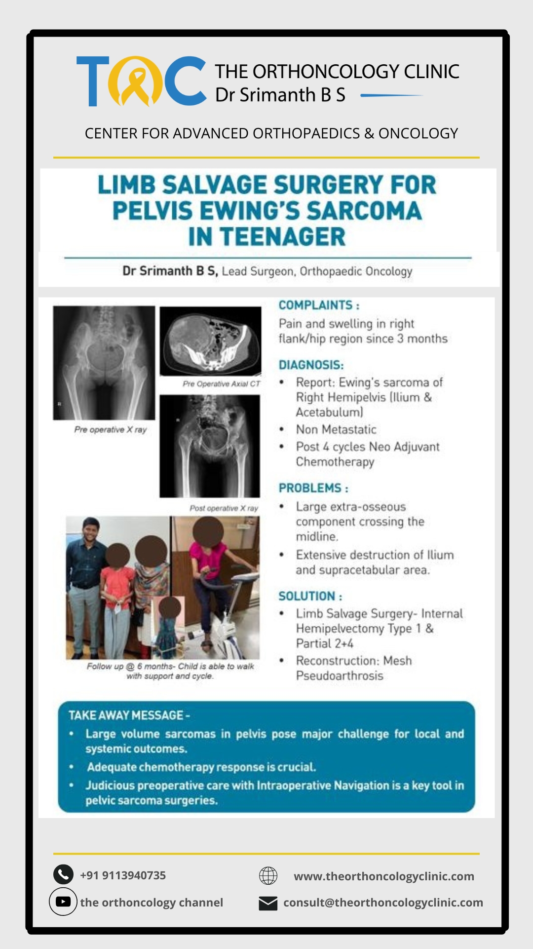 Limb-saving internal hemipelvectomy for Ewing's sarcoma of right hemipelvis in a teenager — pre-op imaging, post-op X-ray and follow-up