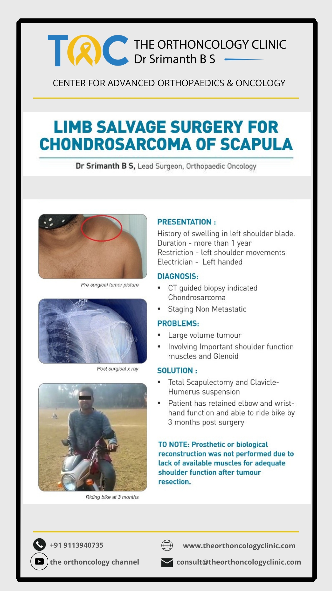 Limb-sparing surgery for chondrosarcoma of scapula — pre-op clinical photo, post-op X-ray and patient riding a bike at 3 months