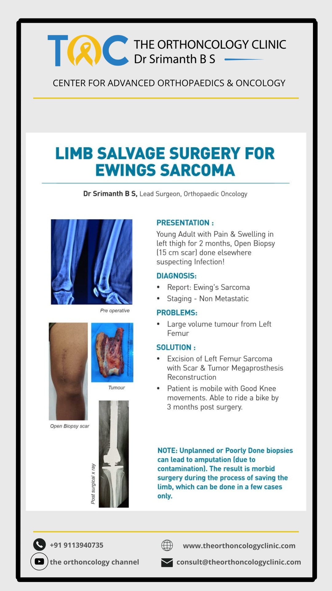 Limb Salvage for Ewing's Sarcoma of Femur