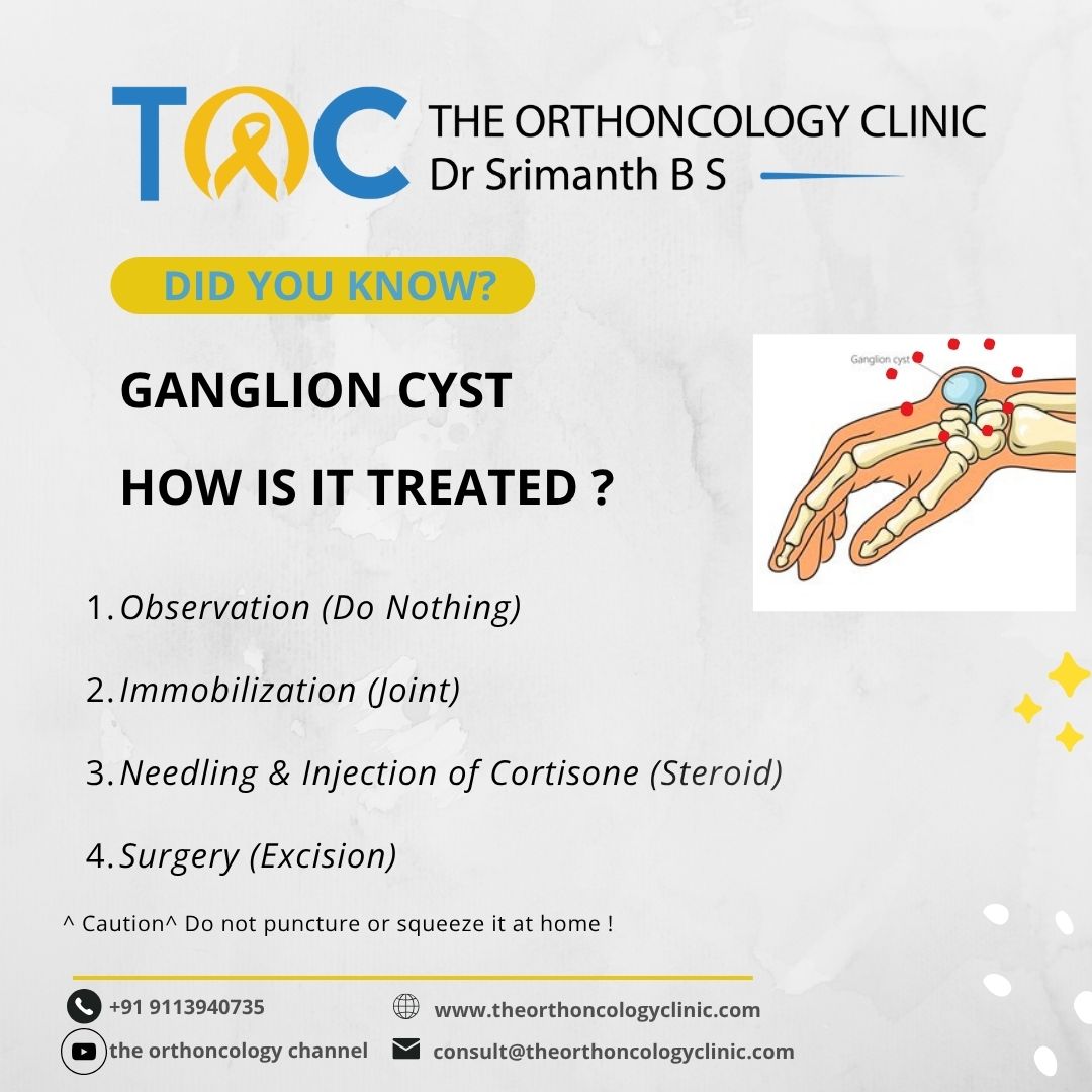 Ganglion Cyst — How is it treated?
