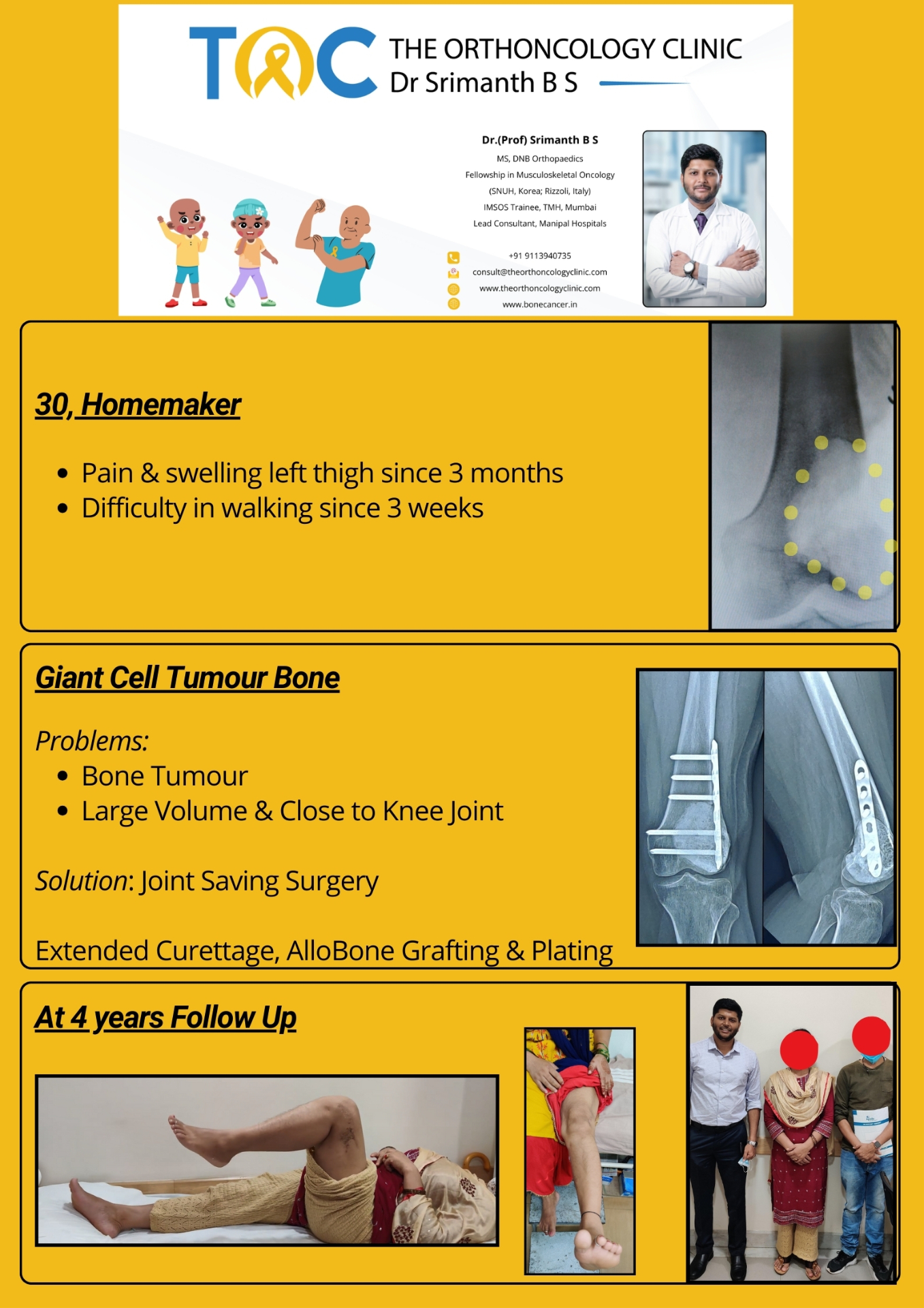 Joint-Saving Surgery — GCT of Distal Femur