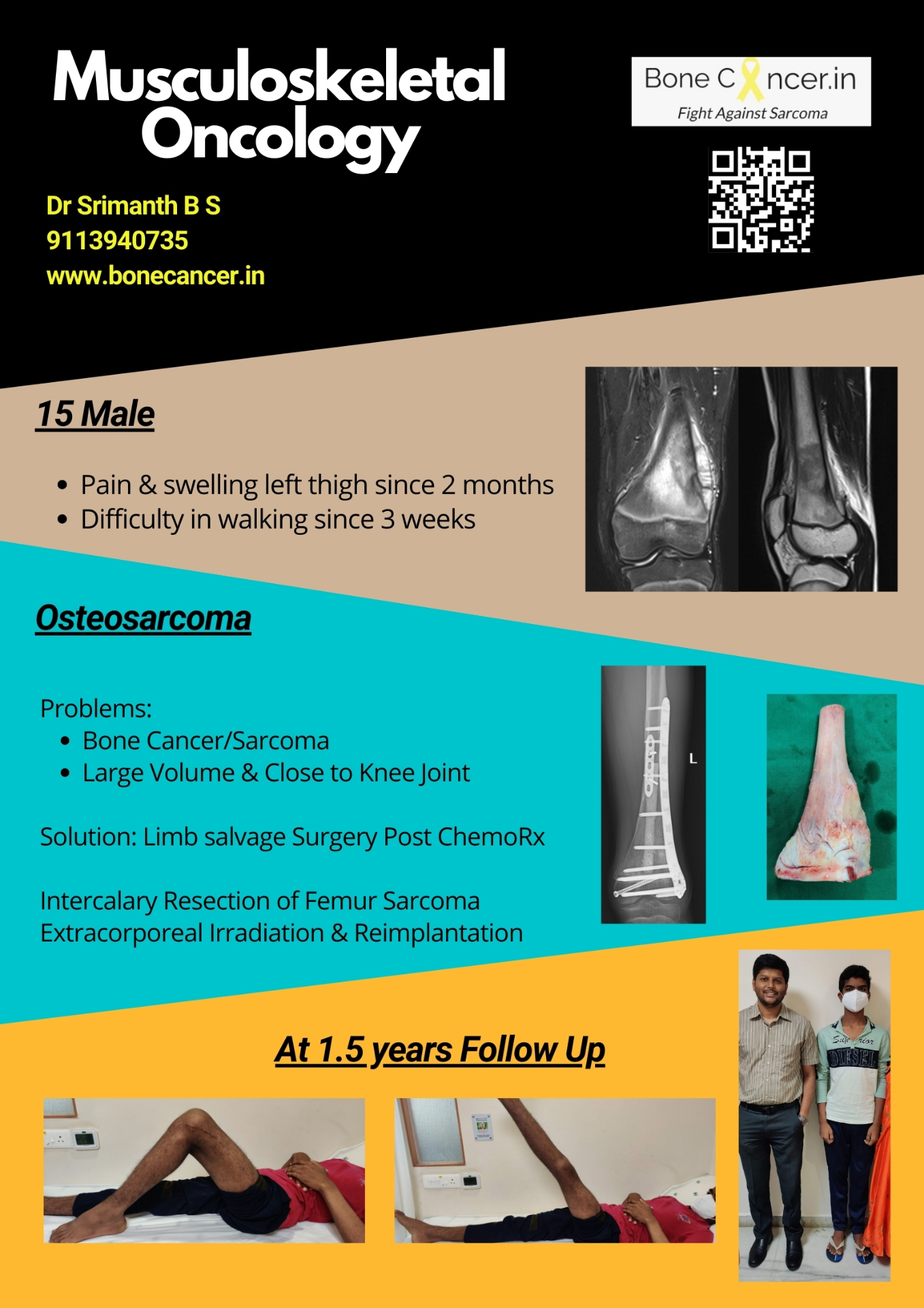 Osteosarcoma of Femur — Biological Limb Salvage