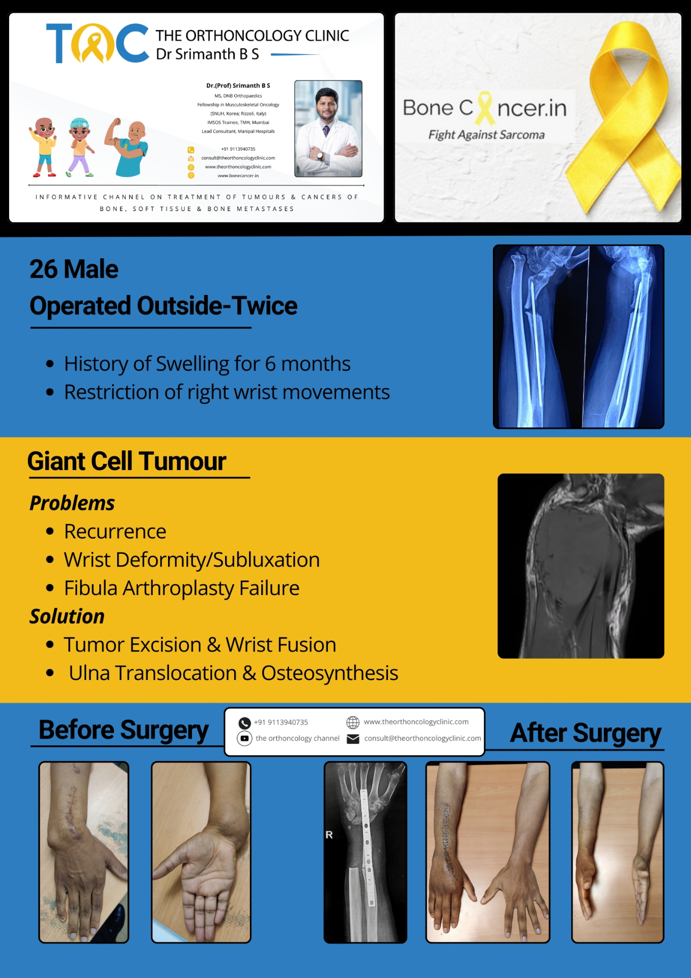 Recurrent GCT of Distal Radius — Twice Operated