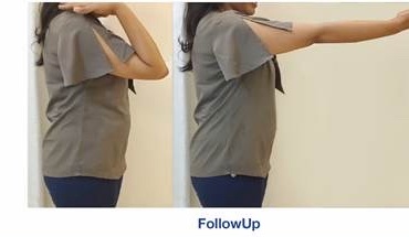 Nine months on — full elbow movement restored, no relapse.
