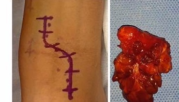 Intra-operative view and the tumour removed en-bloc, in one piece.