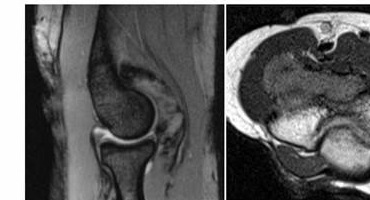 MRI of the elbow — a 3×3 cm tumour sitting snugly inside the joint.